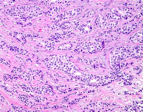 webpathology|Breast .